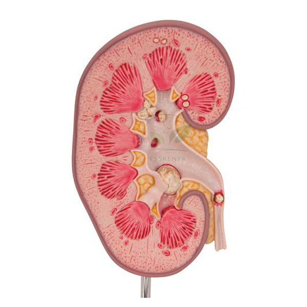Kidney Stone Model
